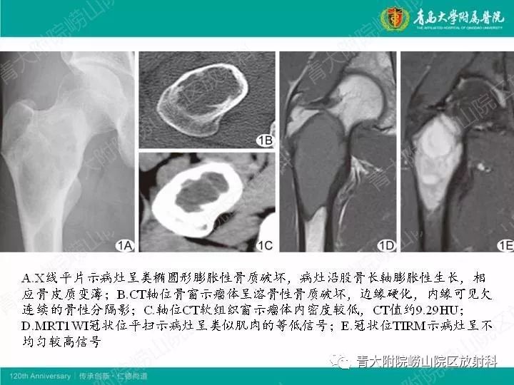【病例】股骨尤文肉瘤1例CT及MR影像