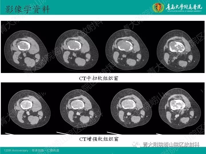 【病例】股骨尤文肉瘤1例CT及MR影像