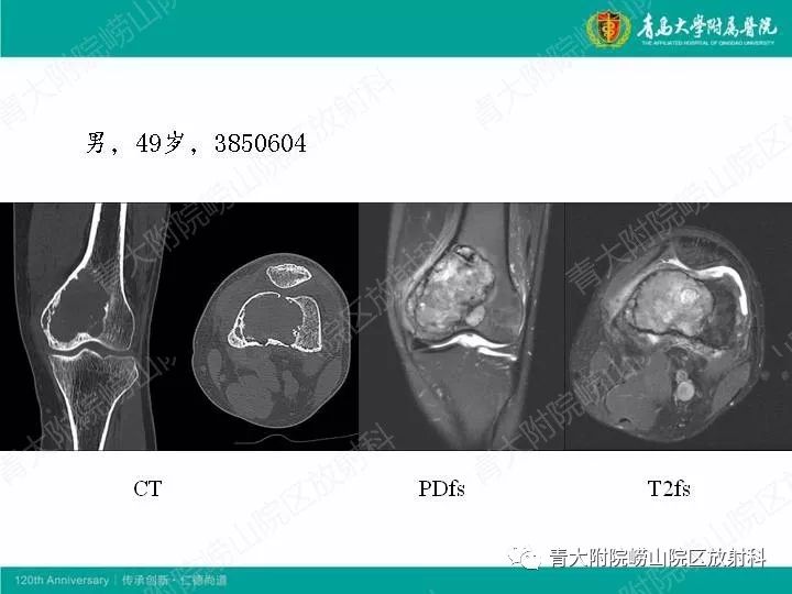 【病例】股骨尤文肉瘤1例CT及MR影像