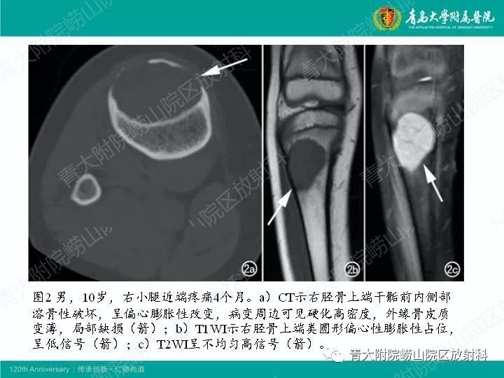 【病例】股骨尤文肉瘤1例CT及MR影像