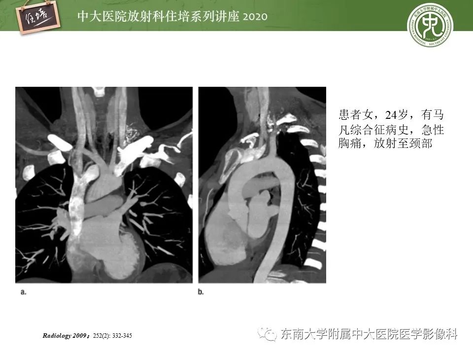 【PPT】胸痛三联CTA的临床应用