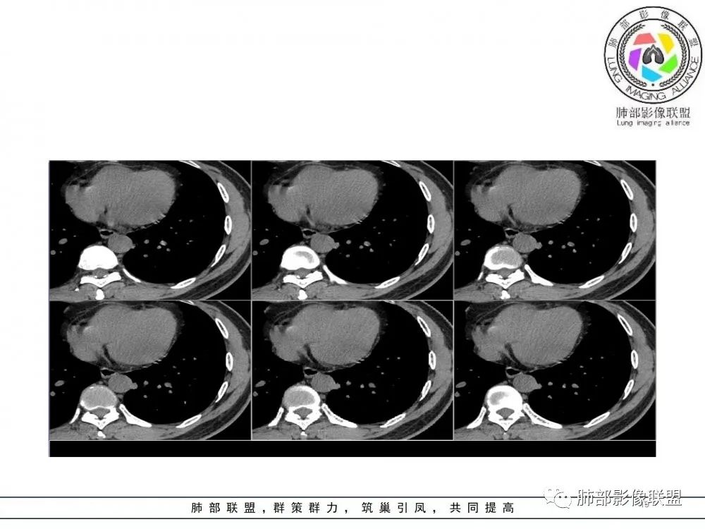 【病例】肺隐球菌病2例CT影像讨论