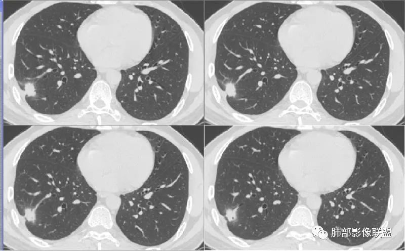 【病例】肺隐球菌病2例CT影像讨论