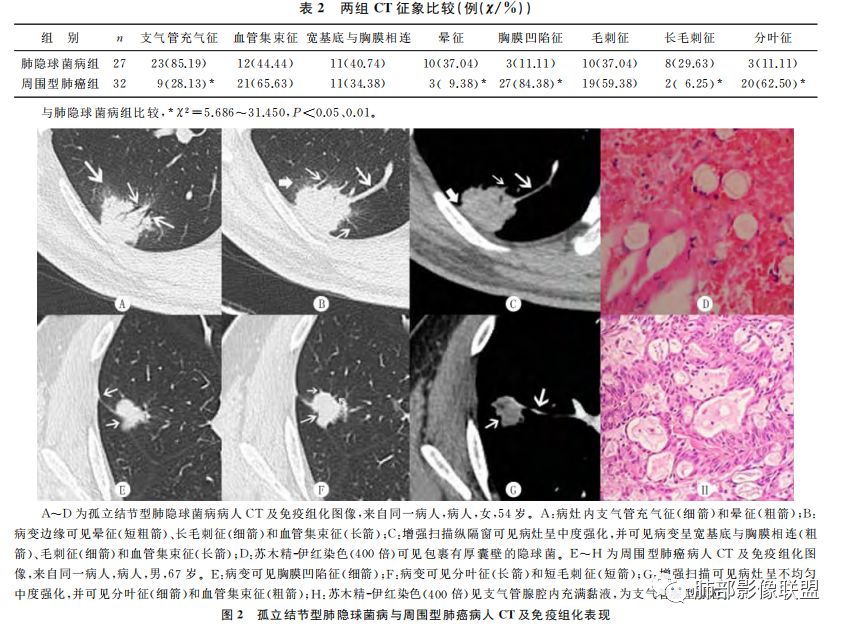 【病例】肺隐球菌病2例CT影像讨论