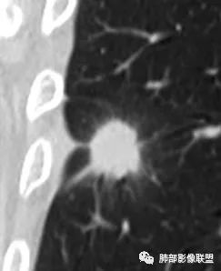 【病例】肺隐球菌病2例CT影像讨论