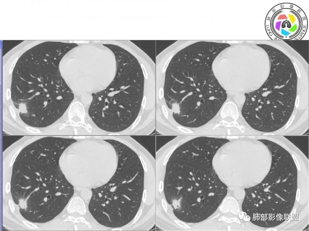 【病例】肺隐球菌病2例CT影像讨论