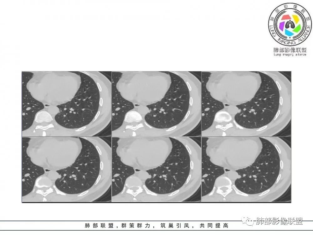 【病例】肺隐球菌病2例CT影像讨论