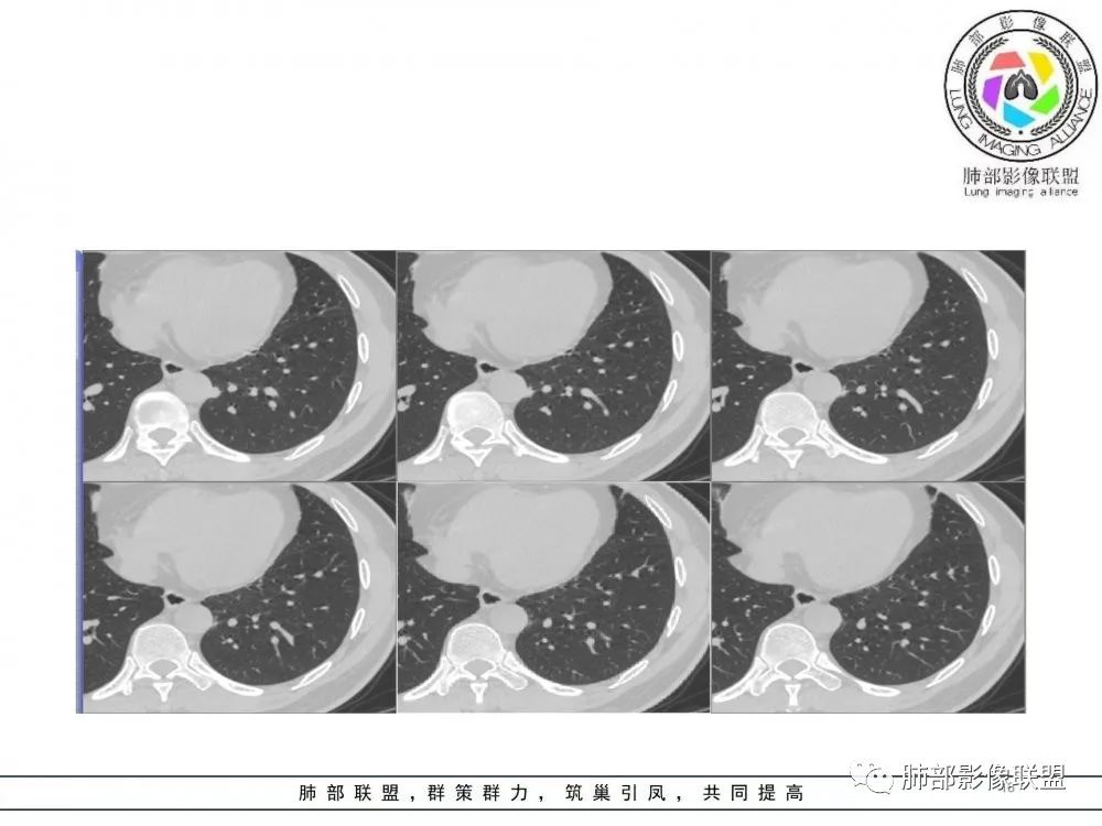 【病例】肺隐球菌病2例CT影像讨论
