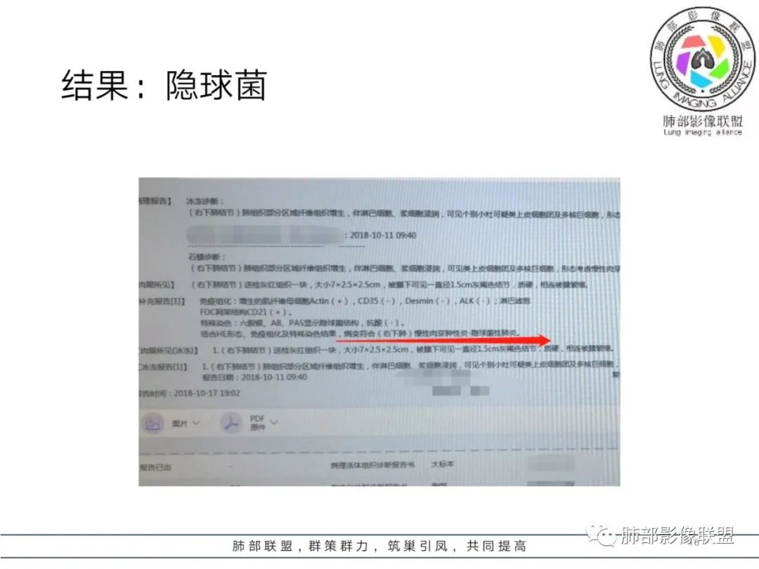 【病例】肺隐球菌病2例CT影像讨论