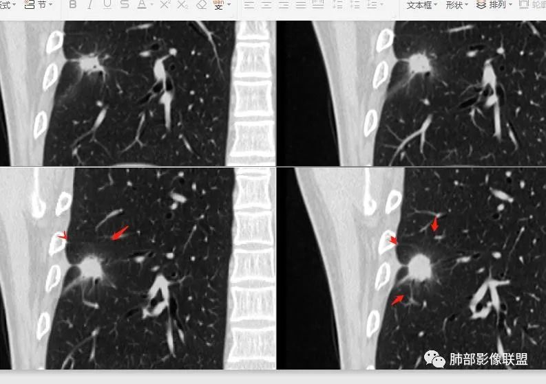 【病例】肺隐球菌病2例CT影像讨论