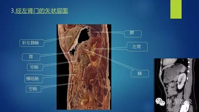 腹部CT超全断层解剖