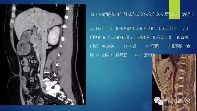 腹部CT超全断层解剖