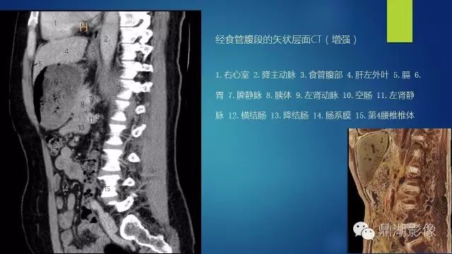 腹部CT超全断层解剖