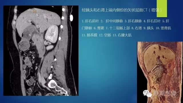 腹部CT超全断层解剖