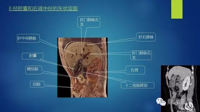 腹部CT超全断层解剖