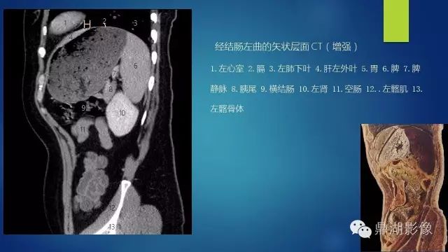 腹部CT超全断层解剖