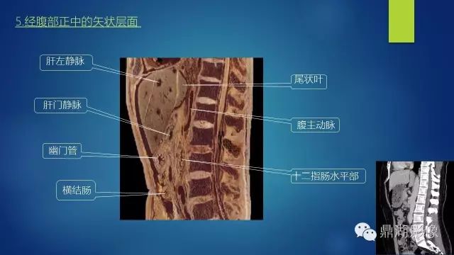 腹部CT超全断层解剖