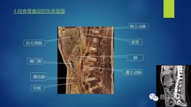 腹部CT超全断层解剖