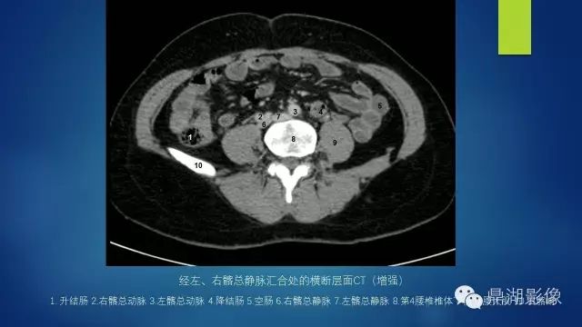 腹部CT超全断层解剖