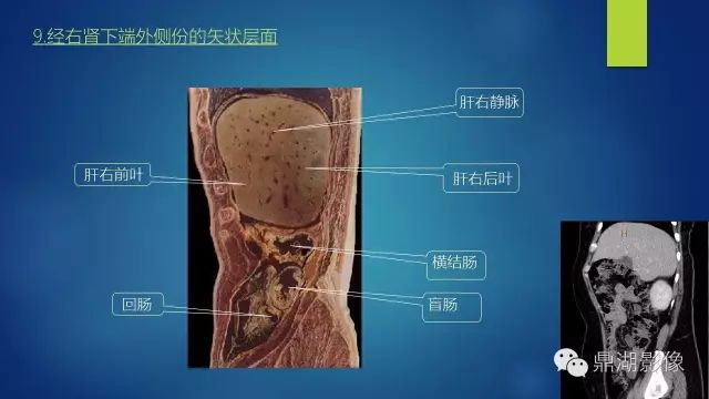 腹部CT超全断层解剖