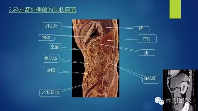 腹部CT超全断层解剖