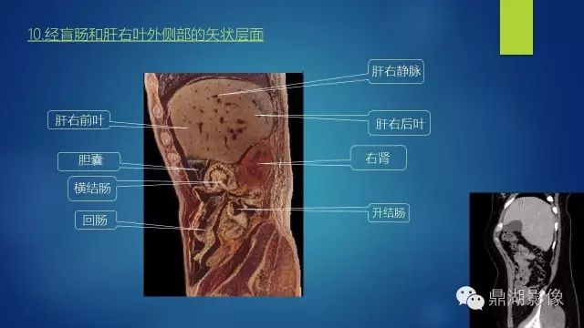 腹部CT超全断层解剖