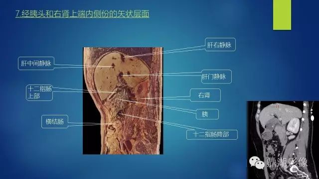 腹部CT超全断层解剖