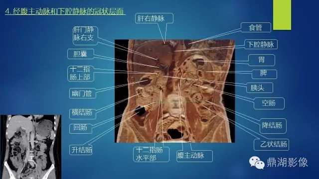 腹部CT超全断层解剖