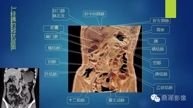 腹部CT超全断层解剖