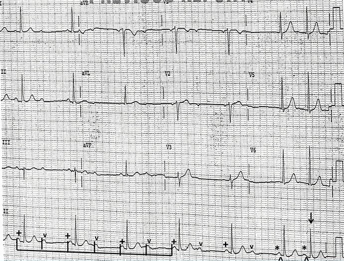 ht_200225_podrid_ECG-7_labeled_690x550.jpg