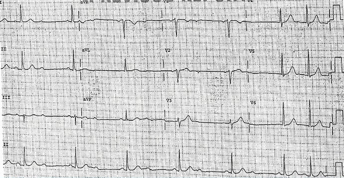 ht_200225_podrid_ECG-7_690x383.jpg