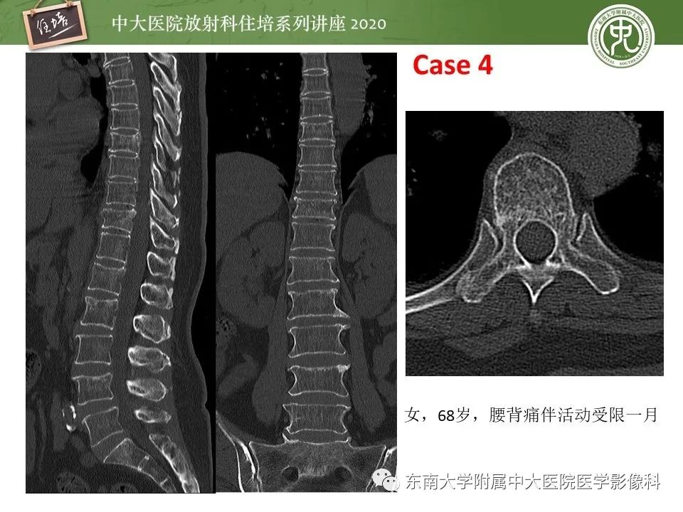 【PPT】脊柱骨源性病变影像分析思路及应用