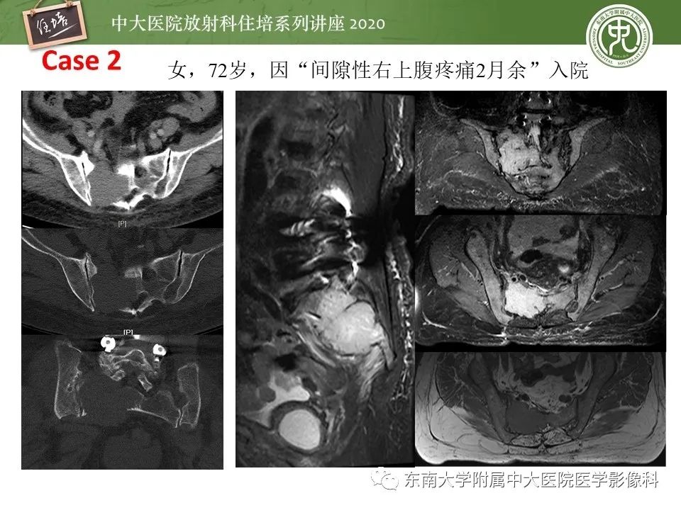 【PPT】脊柱骨源性病变影像分析思路及应用