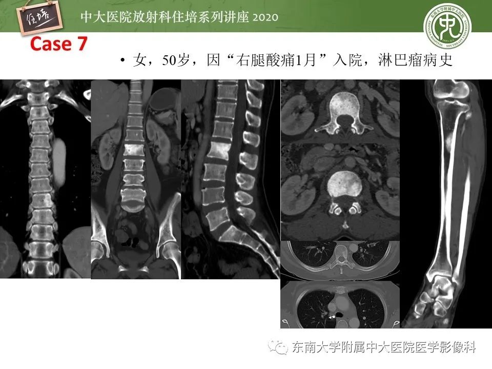 【PPT】脊柱骨源性病变影像分析思路及应用