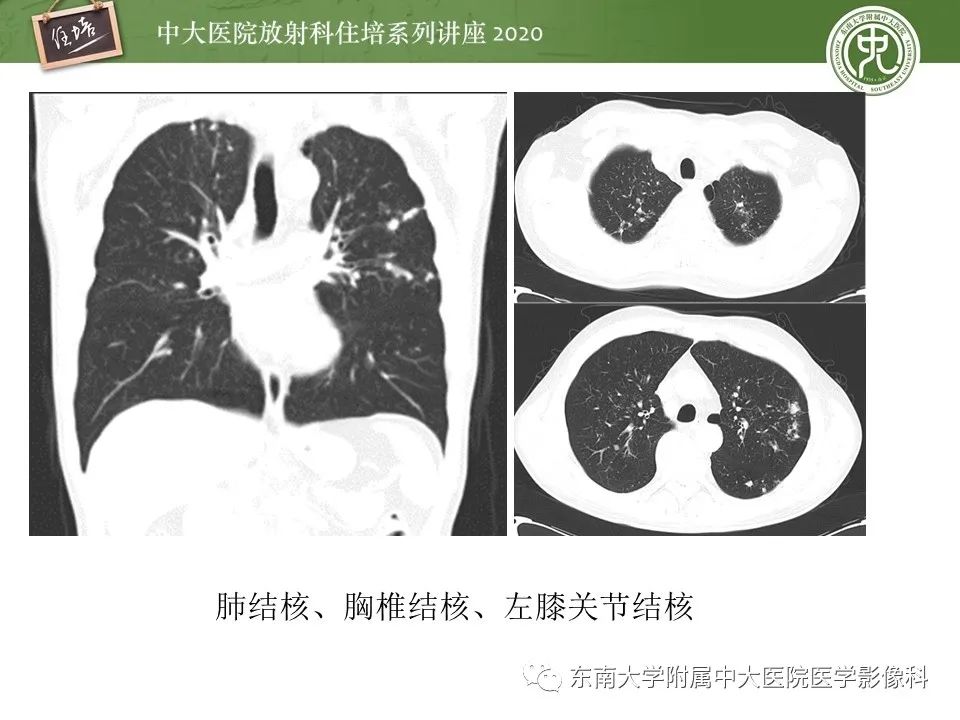 【PPT】脊柱骨源性病变影像分析思路及应用