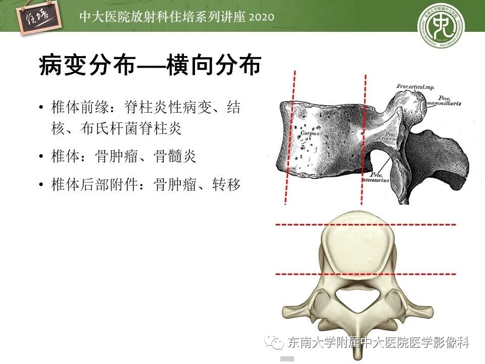 【PPT】脊柱骨源性病变影像分析思路及应用