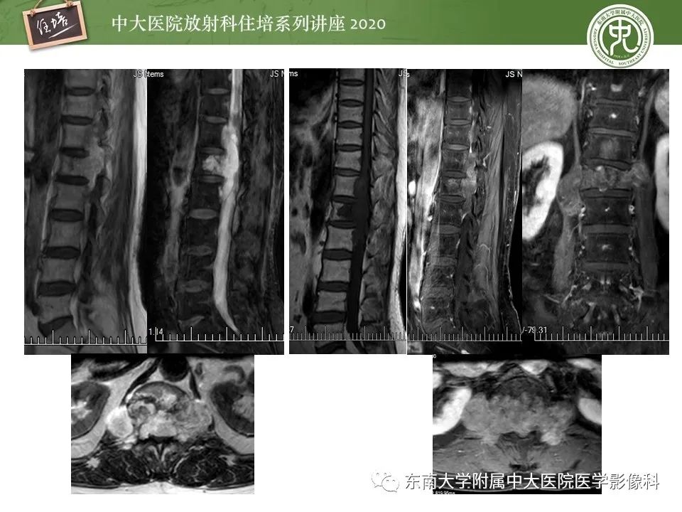 【PPT】脊柱骨源性病变影像分析思路及应用