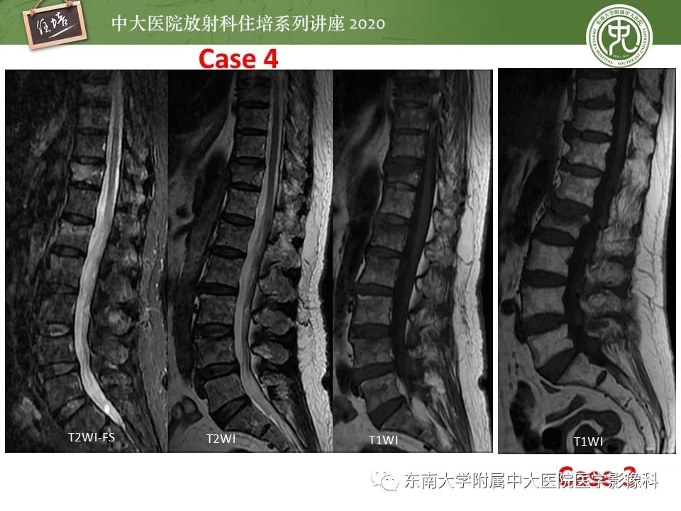 【PPT】脊柱骨源性病变影像分析思路及应用