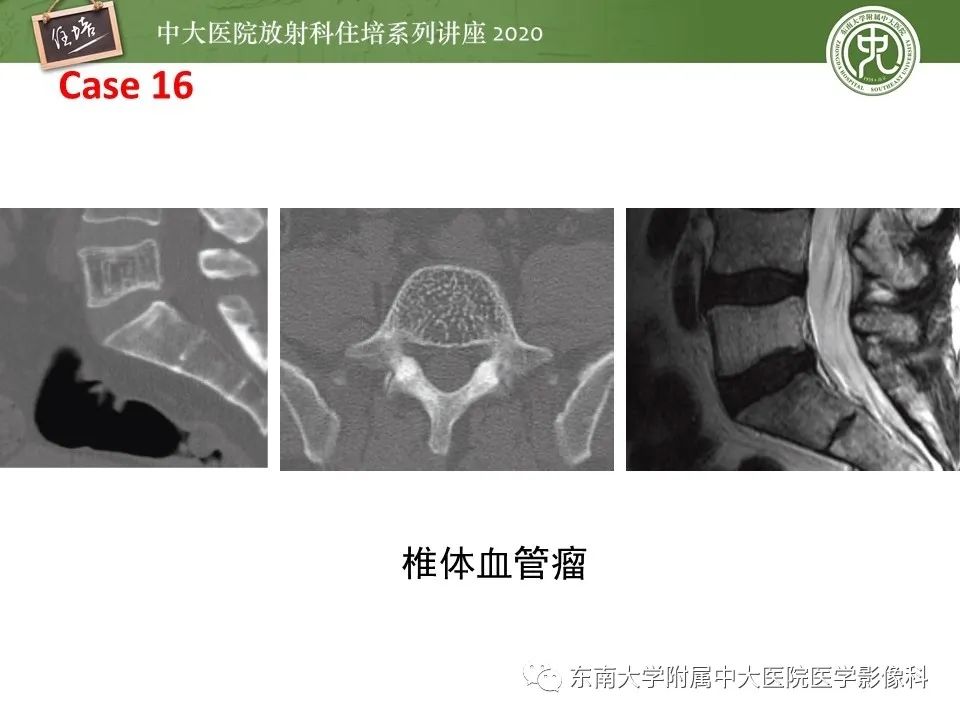 【PPT】脊柱骨源性病变影像分析思路及应用