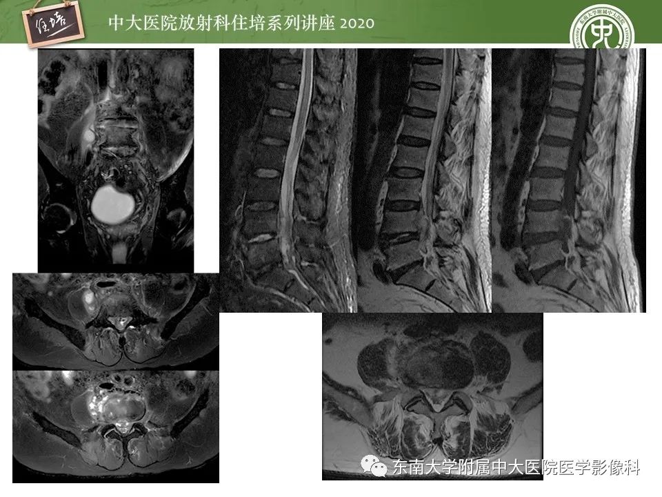 【PPT】脊柱骨源性病变影像分析思路及应用