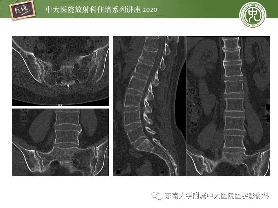 【PPT】脊柱骨源性病变影像分析思路及应用