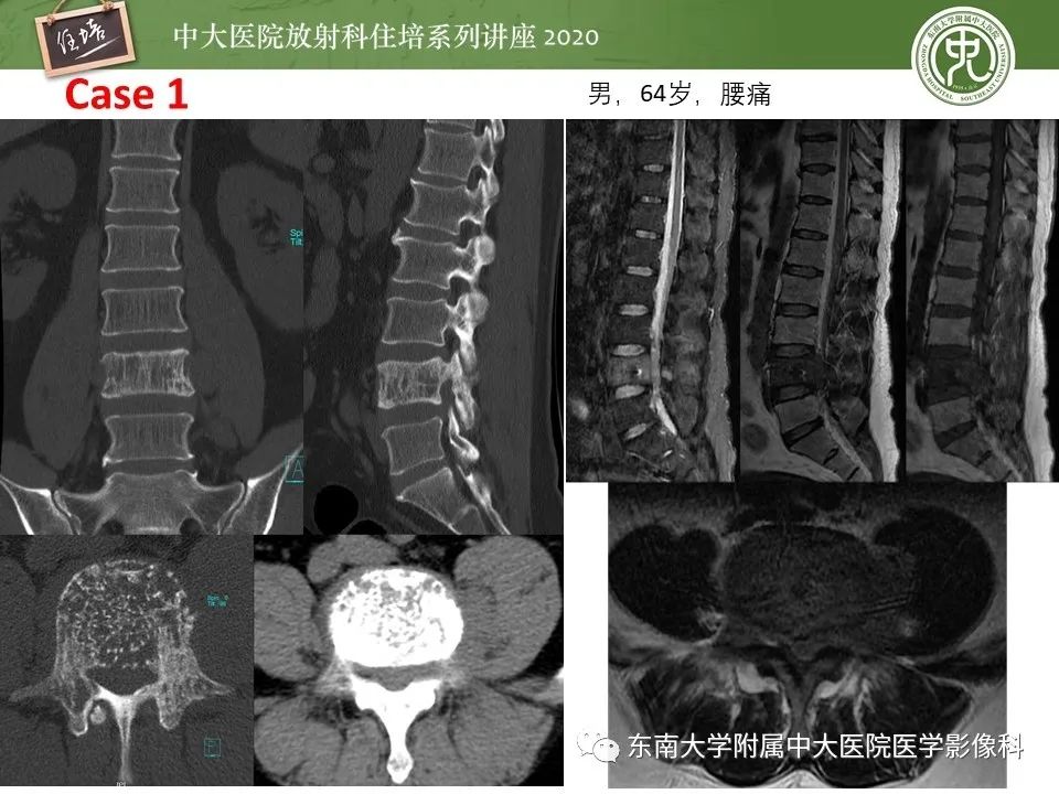 【PPT】脊柱骨源性病变影像分析思路及应用