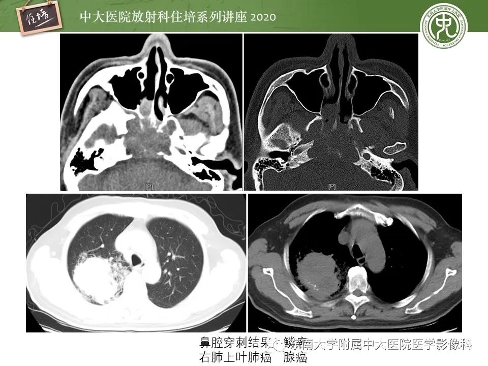 【PPT】脊柱骨源性病变影像分析思路及应用