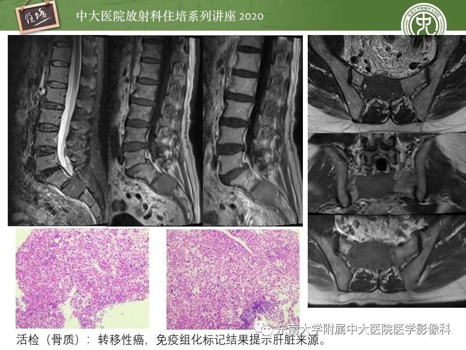 【PPT】脊柱骨源性病变影像分析思路及应用