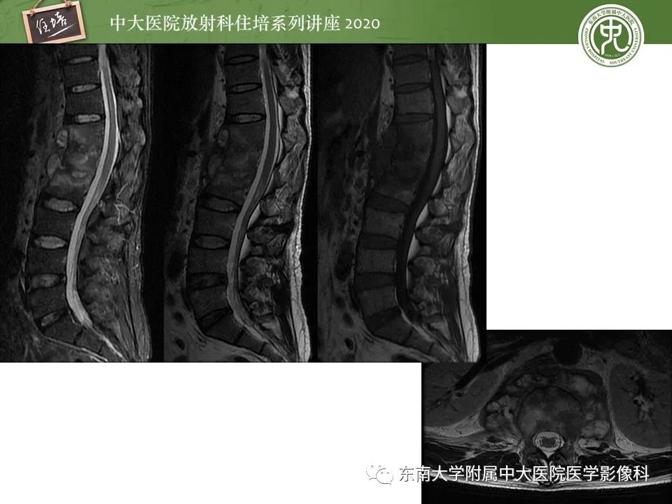 【PPT】脊柱骨源性病变影像分析思路及应用
