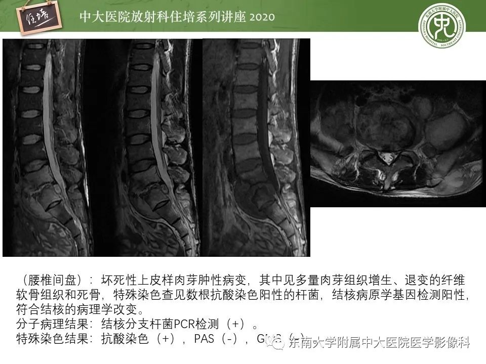 【PPT】脊柱骨源性病变影像分析思路及应用
