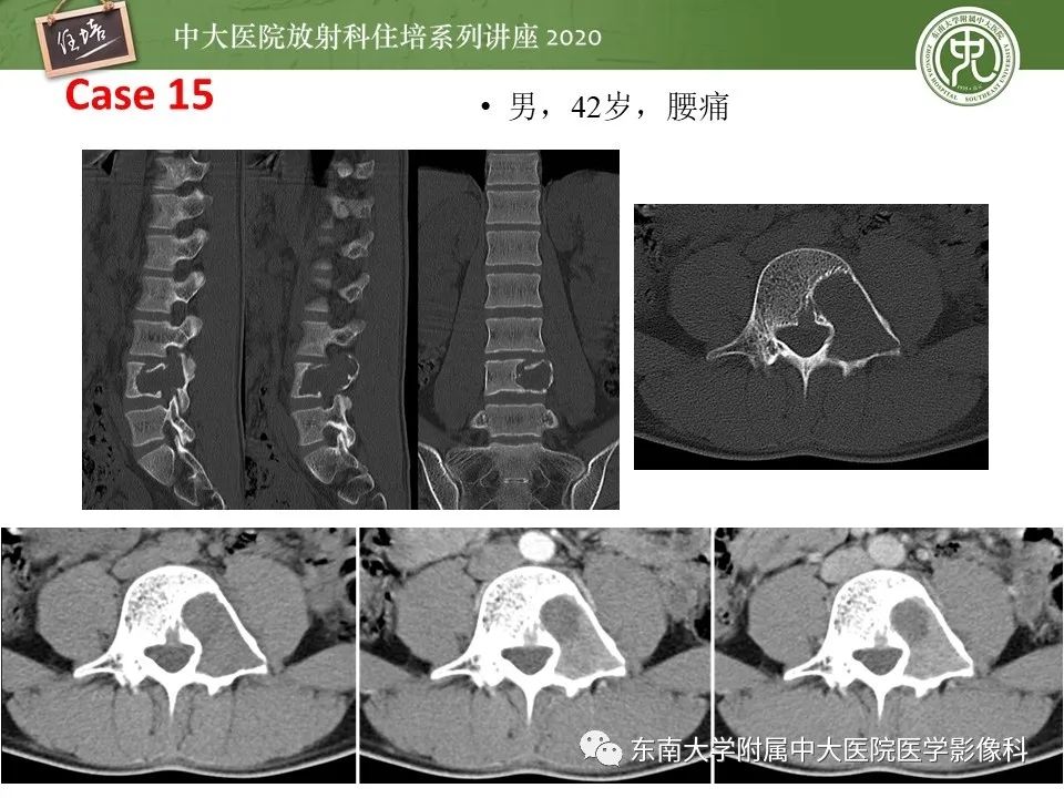 【PPT】脊柱骨源性病变影像分析思路及应用