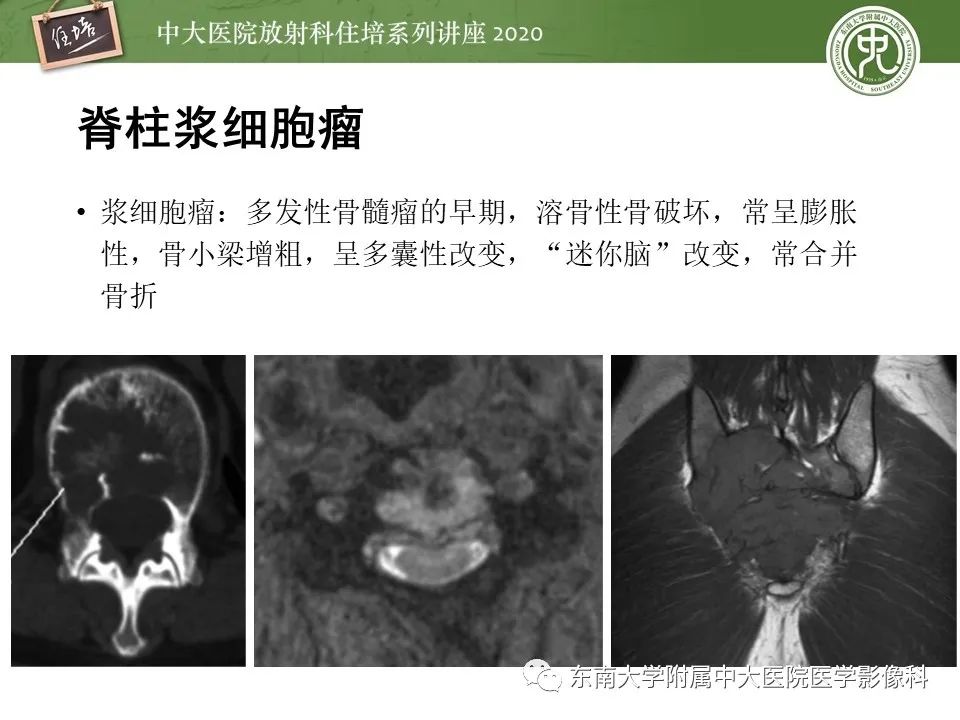 【PPT】脊柱骨源性病变影像分析思路及应用
