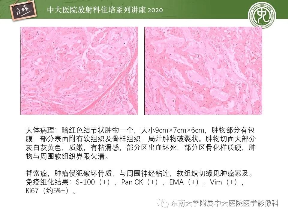 【PPT】脊柱骨源性病变影像分析思路及应用