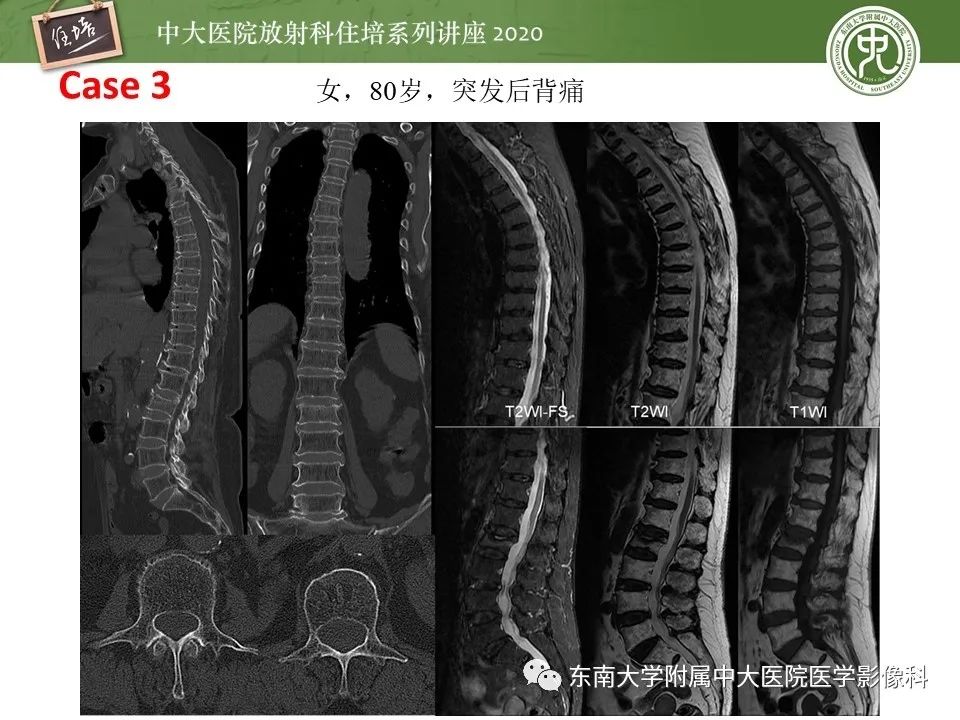 【PPT】脊柱骨源性病变影像分析思路及应用